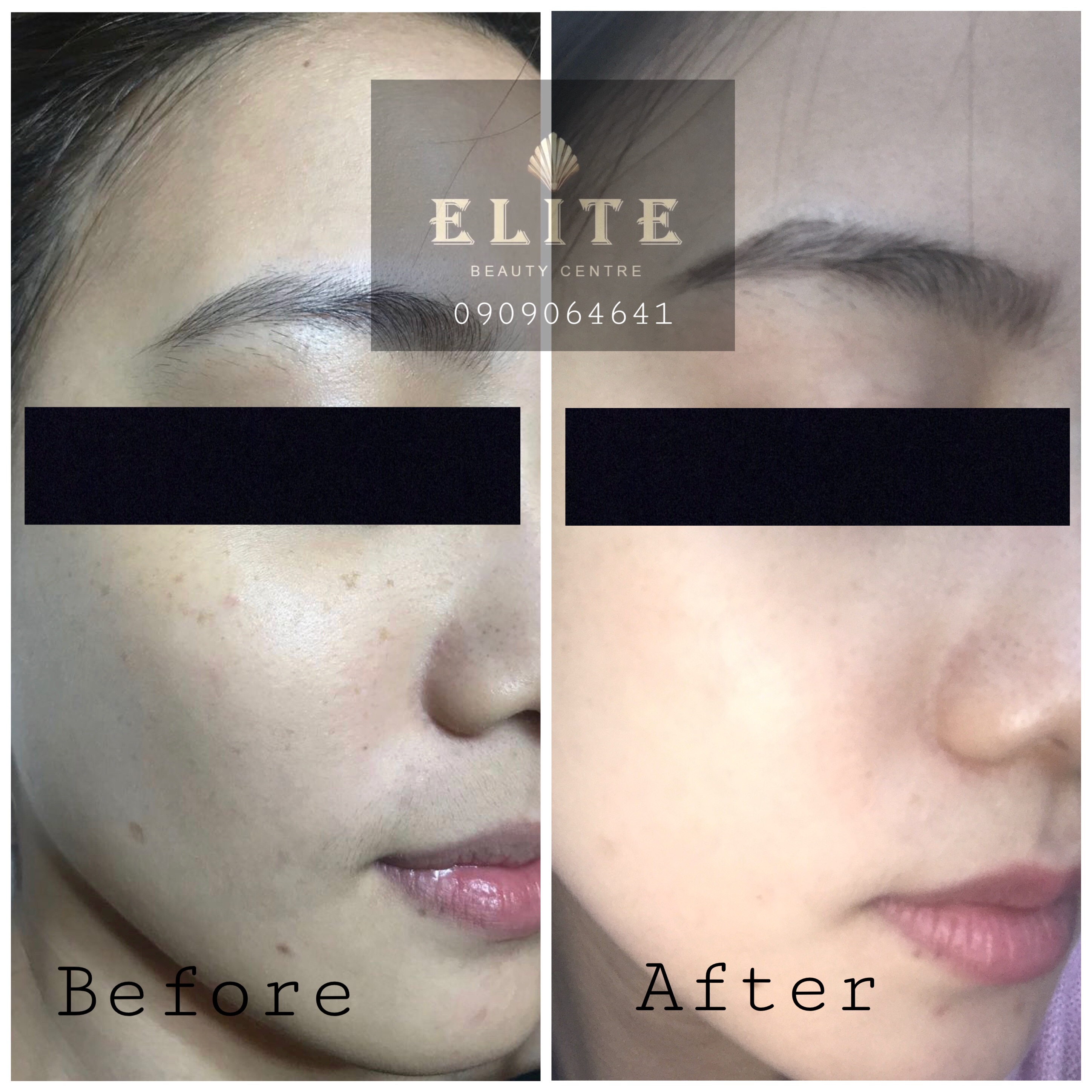 Pigmentation Treatment 